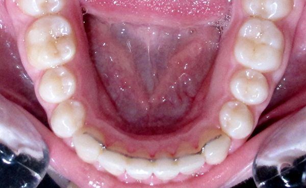 Ortodoncia Adolescentes - Ejemplo 17 - Después