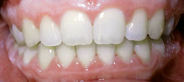 Ortodoncia Adolescentes - Ejemplo 17 - Después