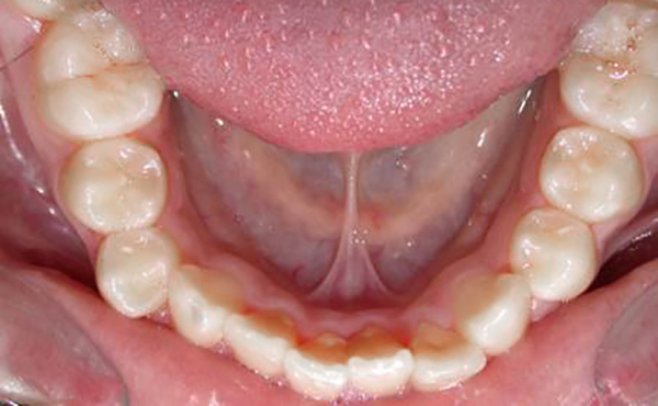 Ortodoncia Adolescentes - Ejemplo 18 - Antes