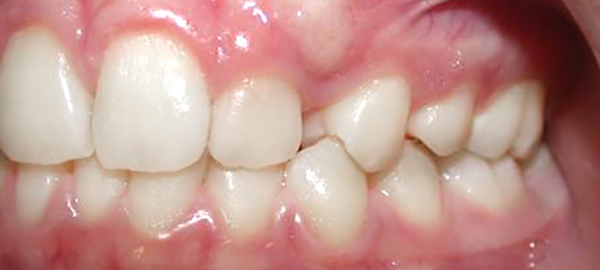 Ortodoncia Adolescentes - Ejemplo 18 - Antes