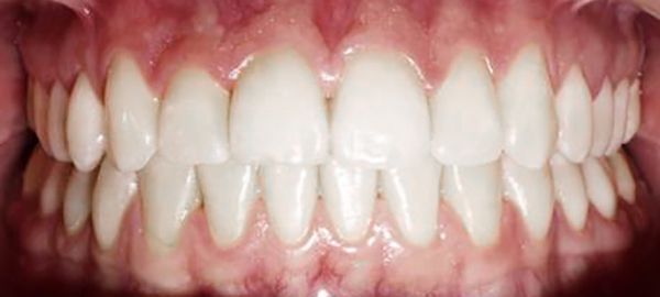 Ortodoncia Adolescentes - Ejemplo 18 - Después