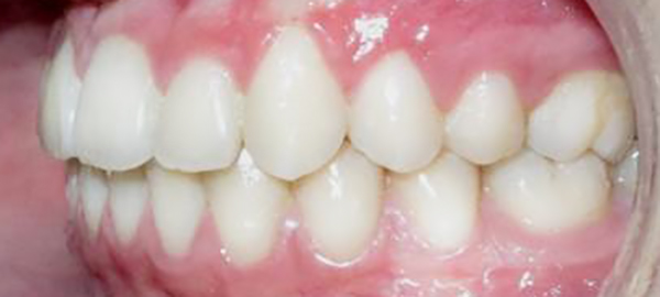 Ortodoncia Adolescentes - Ejemplo 18 - Después