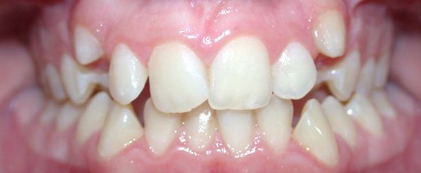 Ortodoncia Adolescentes - Ejemplo 19 - Antes