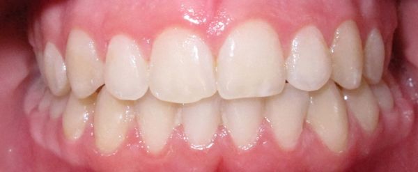 Ortodoncia Adolescentes - Ejemplo 19 - Después