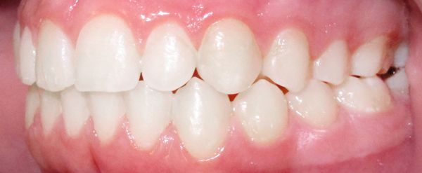 Ortodoncia Adolescentes - Ejemplo 19 - Después