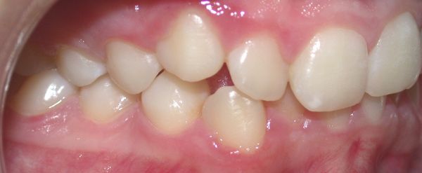 Ortodoncia Adolescentes - Ejemplo 20 - Antes