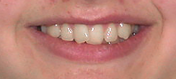 Ortodoncia Adolescentes - Ejemplo 21 - Antes