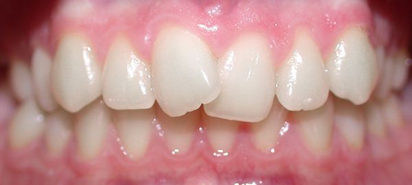 Ortodoncia Adolescentes - Ejemplo 21 - Antes