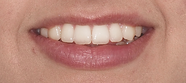 Ortodoncia Adolescentes - Ejemplo 21 - Después