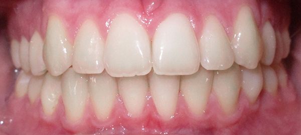 Ortodoncia Adolescentes - Ejemplo 21 - Después