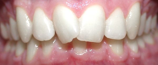 Ortodoncia Adolescentes - Ejemplo 22 - Antes