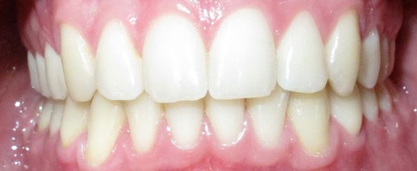 Ortodoncia Adolescentes - Ejemplo 22 - Después