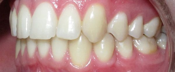 Ortodoncia Adolescentes - Ejemplo 22 - Después