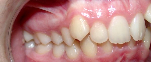 Ortodoncia Adolescentes - Ejemplo 23 - Antes