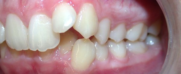 Ortodoncia Adolescentes - Ejemplo 23 - Antes