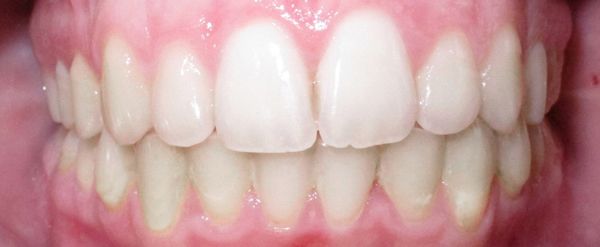 Ortodoncia Adolescentes - Ejemplo 23 - Después