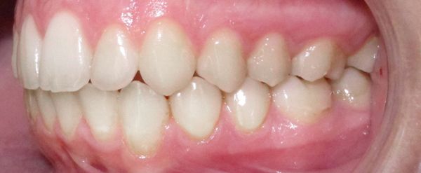 Ortodoncia Adolescentes - Ejemplo 23 - Después
