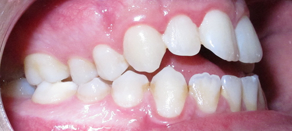 Ortodoncia Adolescentes - Ejemplo 24 - Antes