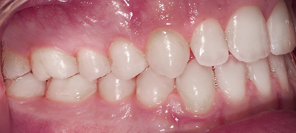 Ortodoncia Adolescentes - Ejemplo 24 - Después