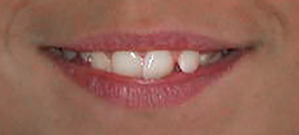 Ortodoncia Adolescentes - Ejemplo 25 - Antes