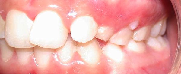 Ortodoncia Adolescentes - Ejemplo 25 - Antes