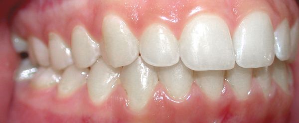 Ortodoncia Adolescentes - Ejemplo 25 - Después
