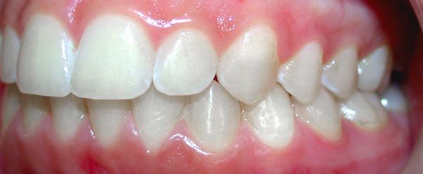 Ortodoncia Adolescentes - Ejemplo 25 - Después