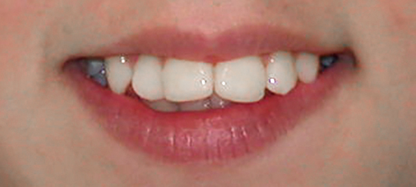 Ortodoncia Adolescentes - Ejemplo 26 - Antes