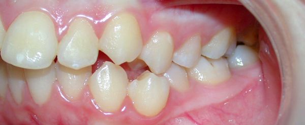 Ortodoncia Adolescentes - Ejemplo 26 - Antes