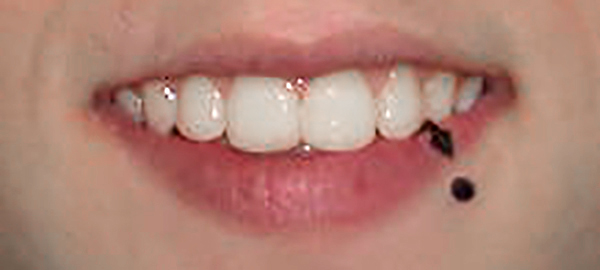 Ortodoncia Adolescentes - Ejemplo 26 - Después