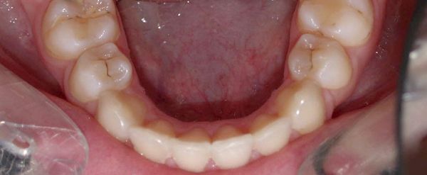 Ortodoncia Adolescentes - Ejemplo 26 - Después