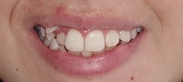 Ortodoncia Adolescentes - Ejemplo 27 - Antes
