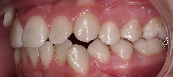 Ortodoncia Adolescentes - Ejemplo 27 - Antes