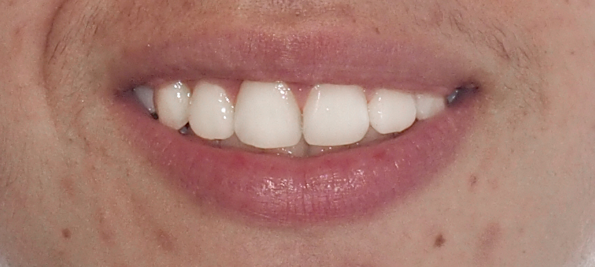Ortodoncia Adolescentes - Ejemplo 27 - Después