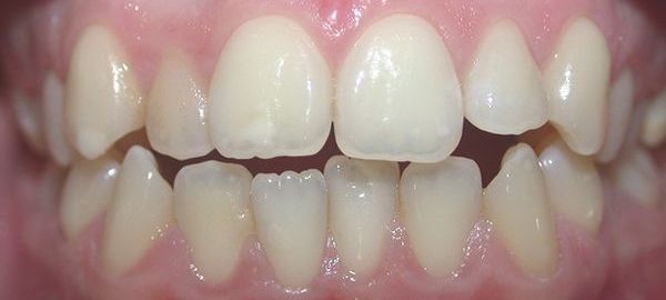 Ortodoncia Adultos - Ejemplo 1 - Antes