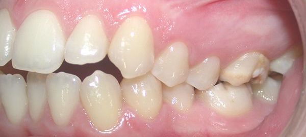 Ortodoncia Adultos - Ejemplo 1 - Antes