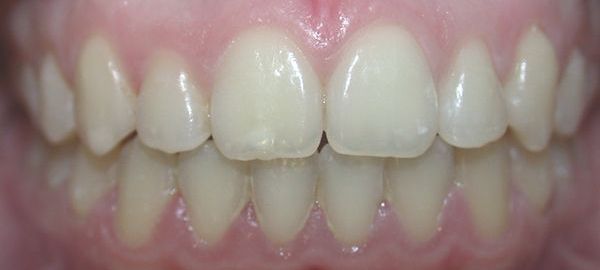 Ortodoncia Adultos - Ejemplo 1 - Después