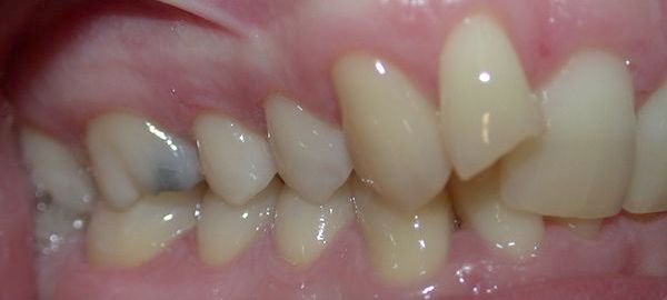 Ortodoncia Adultos - Ejemplo 2 - Antes