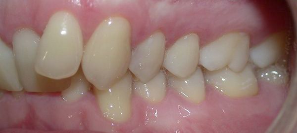 Ortodoncia Adultos - Ejemplo 2 - Antes