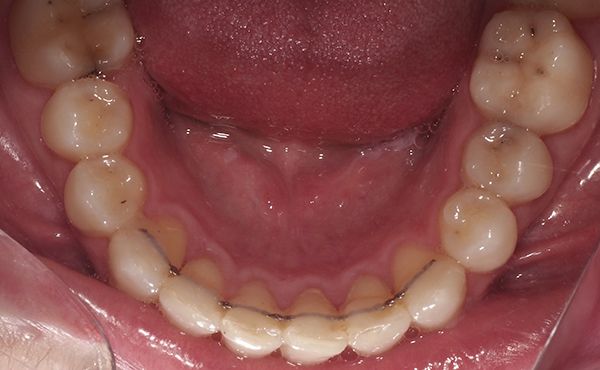 Ortodoncia Adultos - Ejemplo 2 - Después