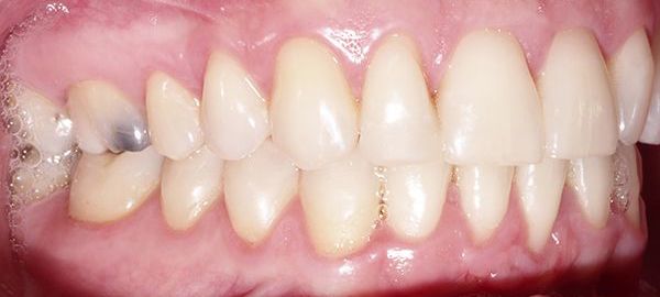 Ortodoncia Adultos - Ejemplo 2 - Después