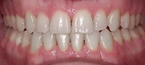 Ortodoncia Adultos - Ejemplo 3 - Después