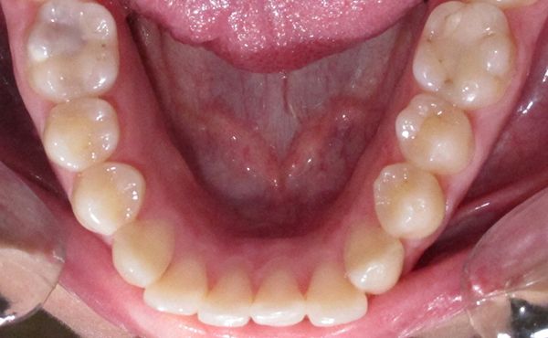 Ortodoncia Adultos - Ejemplo 4 - Antes