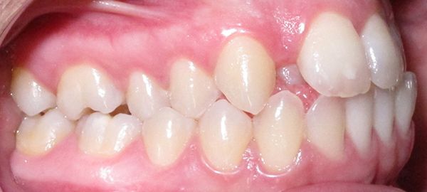 Ortodoncia Adultos - Ejemplo 4 - Antes