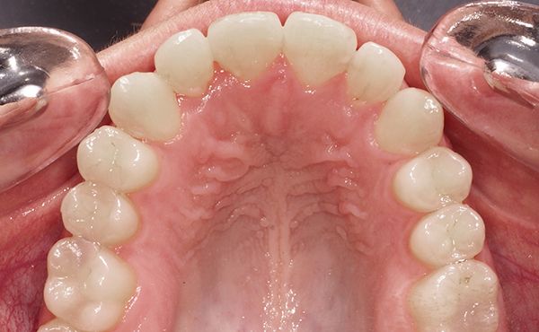 Ortodoncia Adultos - Ejemplo 4 - Después