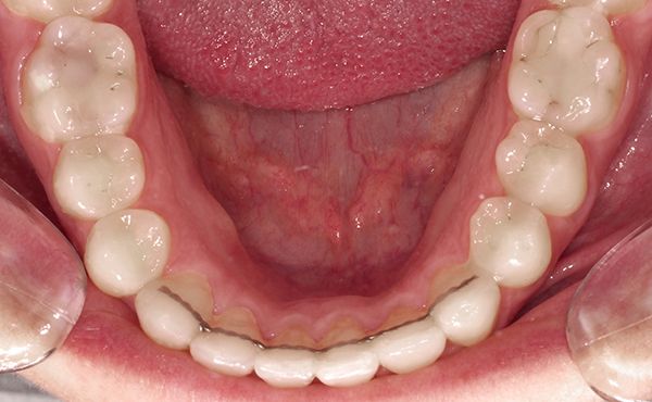 Ortodoncia Adultos - Ejemplo 4 - Después