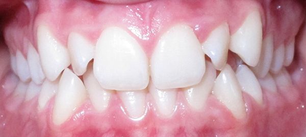 Ortodoncia Adultos - Ejemplo 5 - Antes