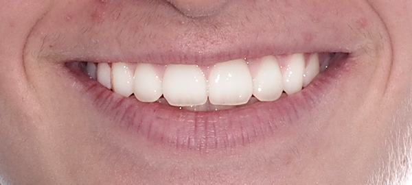 Ortodoncia Adultos - Ejemplo 5 - Después