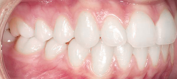 Ortodoncia Adultos - Ejemplo 5 - Después