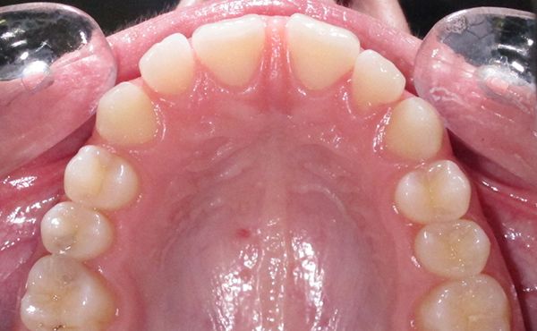 Ortodoncia Adultos - Ejemplo 6 - Antes
